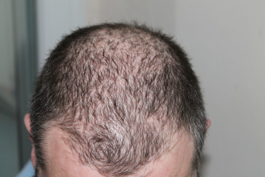 Hair Transplantation